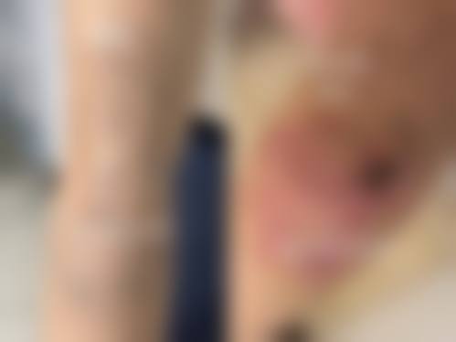 皮肤疤痕体质怎么治疗——辽宁曙光整形外科医院