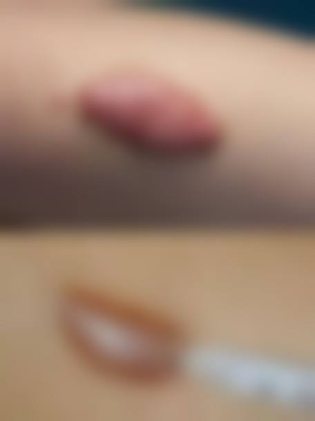 皮肤疤痕体质怎么治疗——广东药科 大学附属第三医院