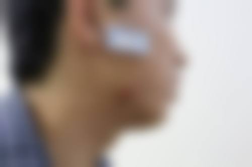 皮肤疤痕体质怎么治疗——合肥市第二人民医院