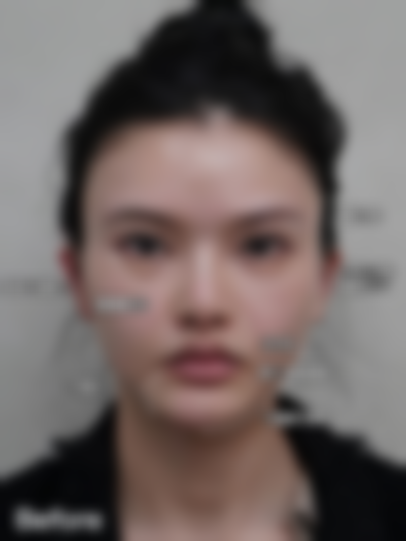 莲湖区最出名的医美医生徐智慧21年经验，玻尿酸塑形364元起，案例见证自然美！