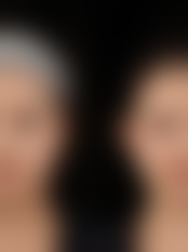 双眼皮割了有后遗症吗——北京同仁医院的优势