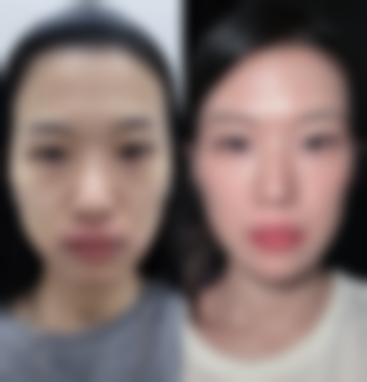 小针除皱成效好不好——吉林市中妍整形美容医院