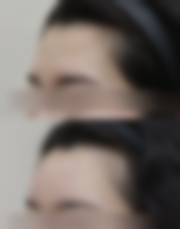 隆鼻玻尿酸什么价——长沙欣颜医疗美容医院