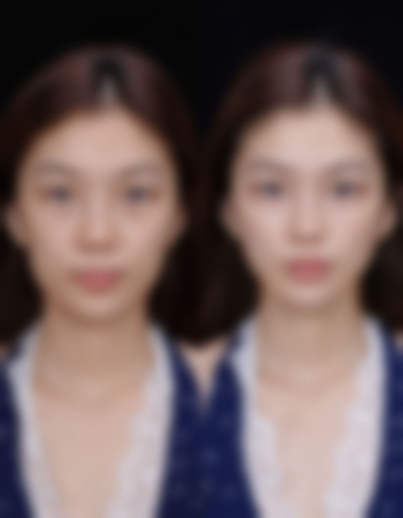 绿毒瘦脸针成效明显程度展现