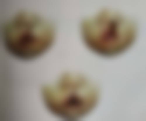 埋线双眼皮一个宽一个窄能修复好吗——深圳米兰柏羽医疗美容整形医院