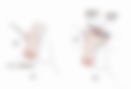 怎么有效去除黑眼袋:物理治疗方法解析