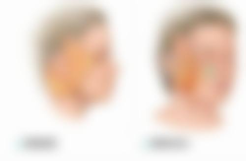 身体肥胖抽脂前的准备工作