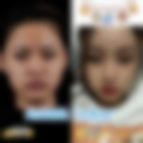 隆鼻鼻头有点歪怎么办——成都艺星