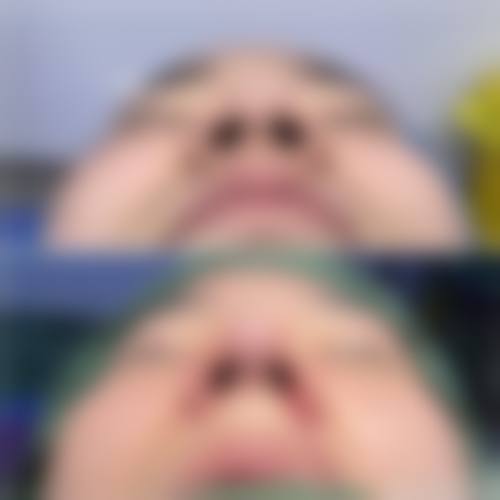 隆鼻鼻头有点歪怎么办？可手法复位或找周顺波医生修复更自然