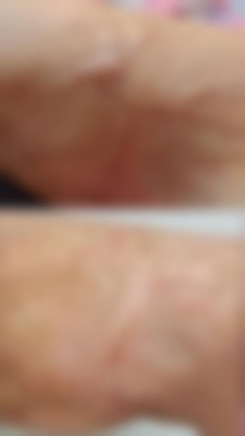 手术疤痕增生如何治疗？SRT100浅放+巴克疗法高效祛疤修复