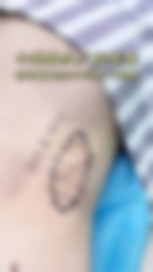 手术疤痕增生如何治疗——美容整形综合医院