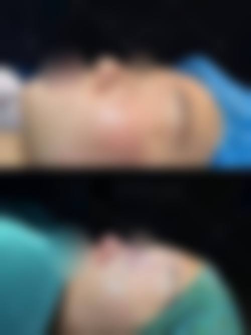 隆鼻鼻头有点歪怎么办——西安美莱医学美容医院