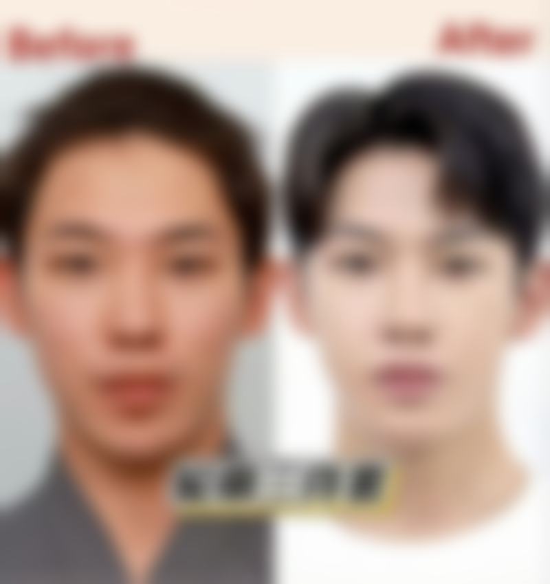 用什么能去除疤痕——手术祛疤：精细的“疤痕雕刻家”