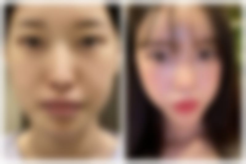 身体肥胖抽脂的费用明细