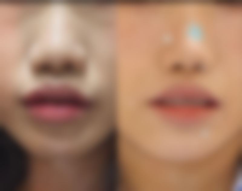 孩子脸上被指甲划伤的疤痕处理——综合类医院(陶以成医生所在)