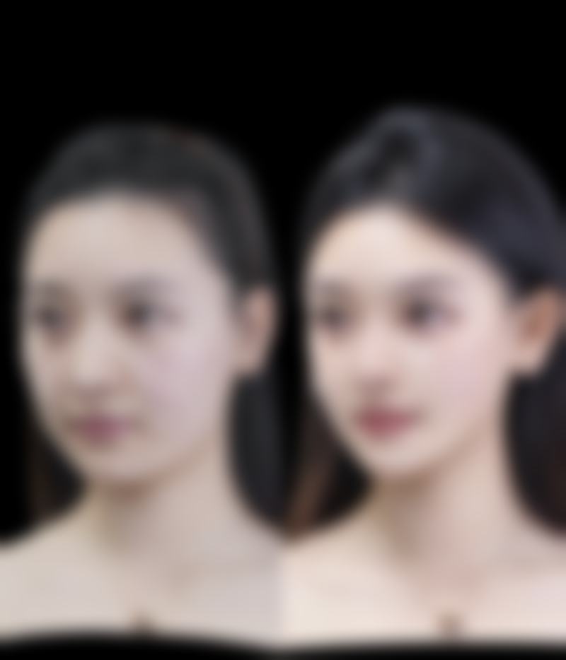 激光治疗：烧伤疤痕的 “光魔法”能否去掉疤痕