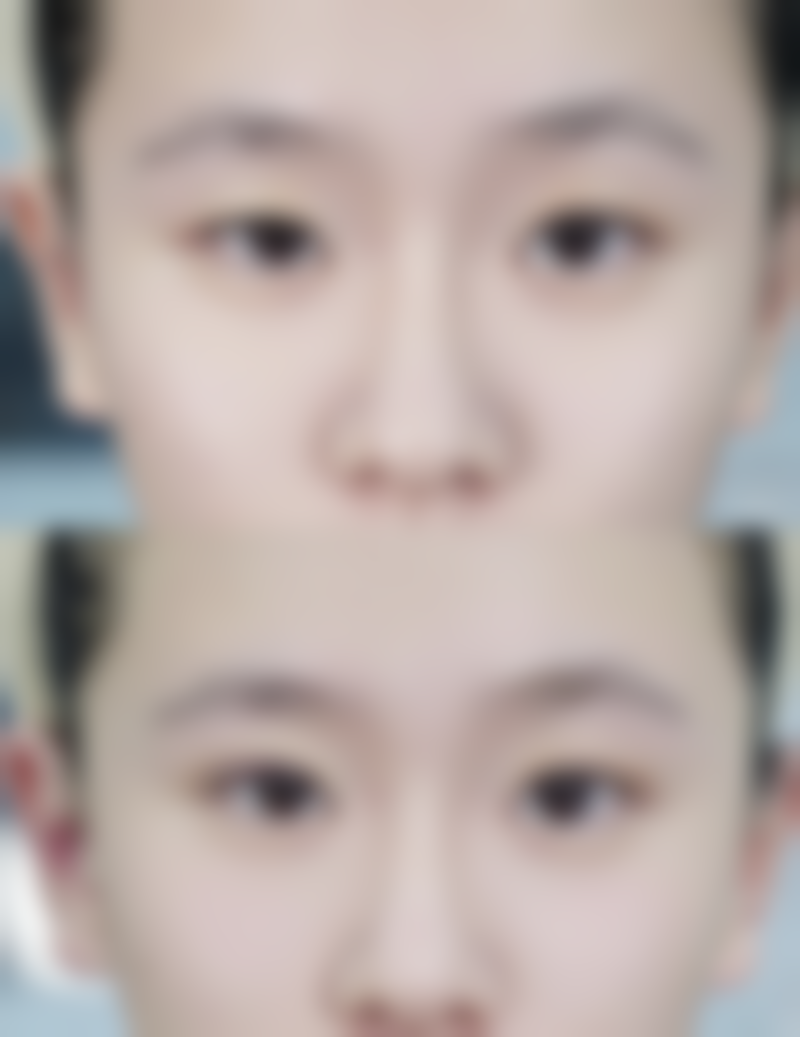 用什么能去除疤痕？药物+激光双管齐下，淡化痘印疤痕不留痕