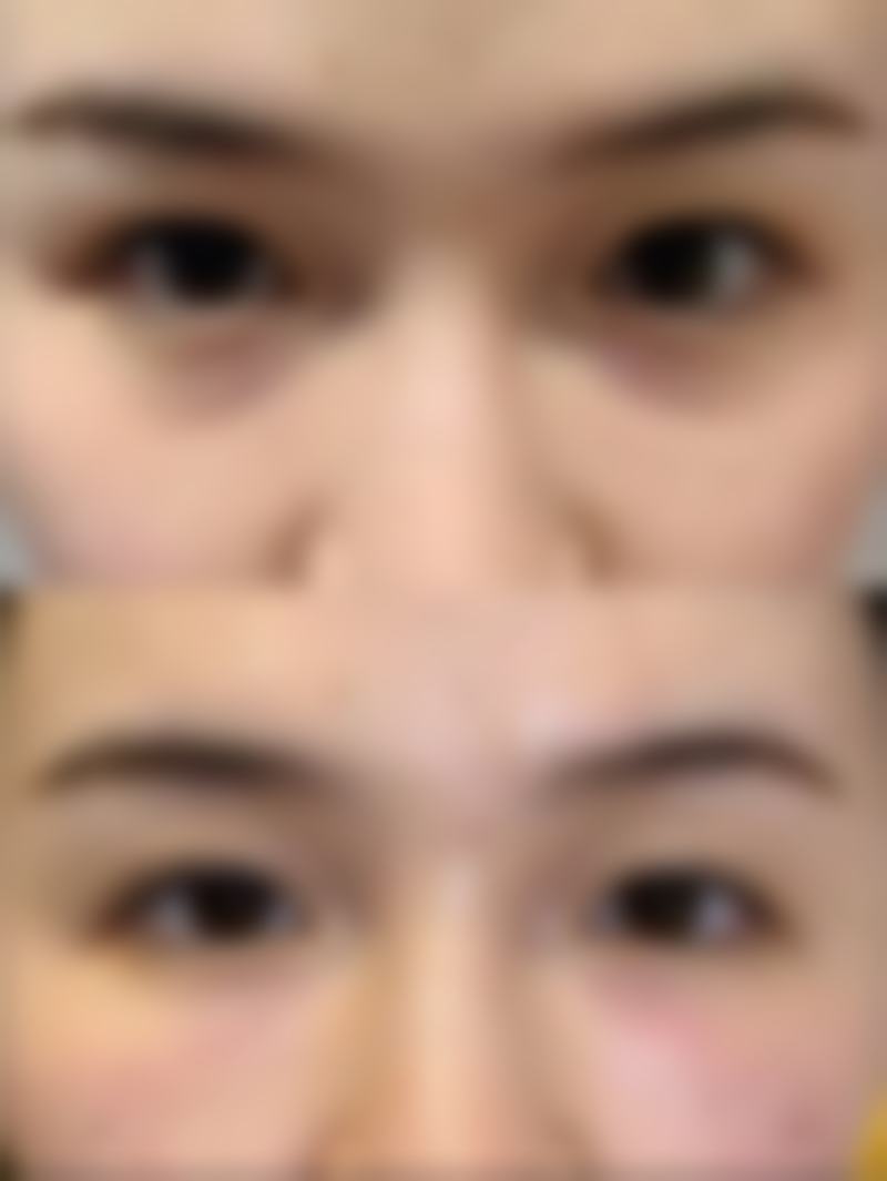 眼袋有泪沟应该怎样去除：手术成效，自然年轻持久稳定