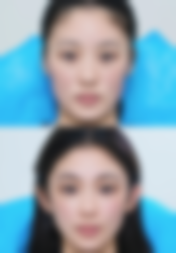 面部吸脂：正规操作与不当操作的天壤之别