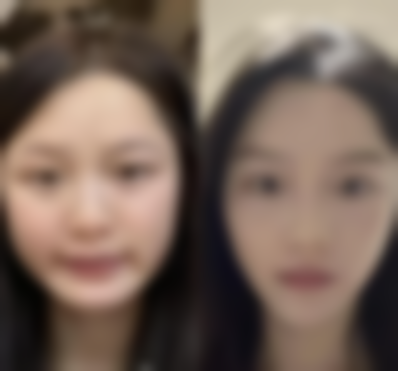 眼袋有泪沟应该怎样去除：适合的眼霜推荐，辅助护理特别重要