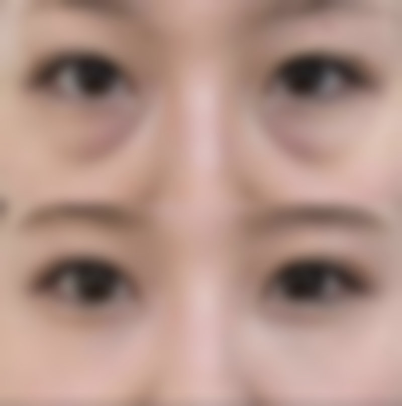 眼袋有泪沟应该怎样去除：眶隔脂肪释放术+外切法的神奇魅力