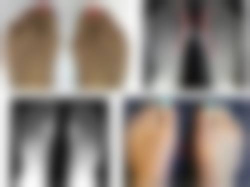 50岁可以做双眼皮全切吗？专家解析恢复时间与自然效果关键点