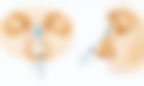 疤痕疙瘩怎么去除呢，手术激光药物全解析，中医妙招护理要点