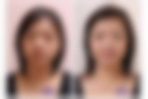 适合50岁做双眼皮全切的医院选择