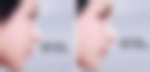 硅胶假体隆胸术后多久能放心触摸