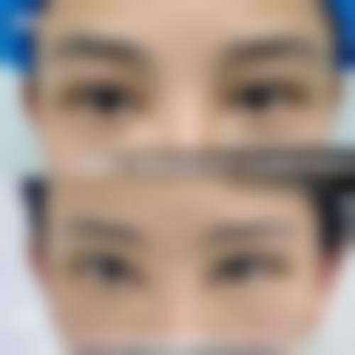 全切双眼皮切眼袋消肿情况——沈阳杏林整形外科医院