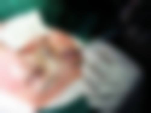 全切双眼皮切眼袋消肿情况——上海中 医 药大学附属曙光医院