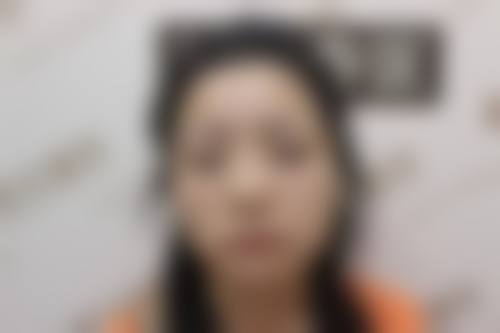 全切双眼皮多久能吃牛肉——钱瑾医生所在医院