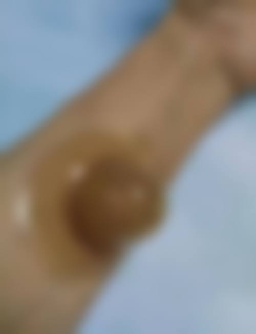 隆胸手术属于大手术吗？——北京美莱