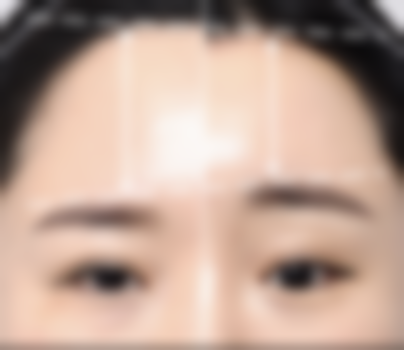 何时是去除疤痕疙瘩的至佳时间呢