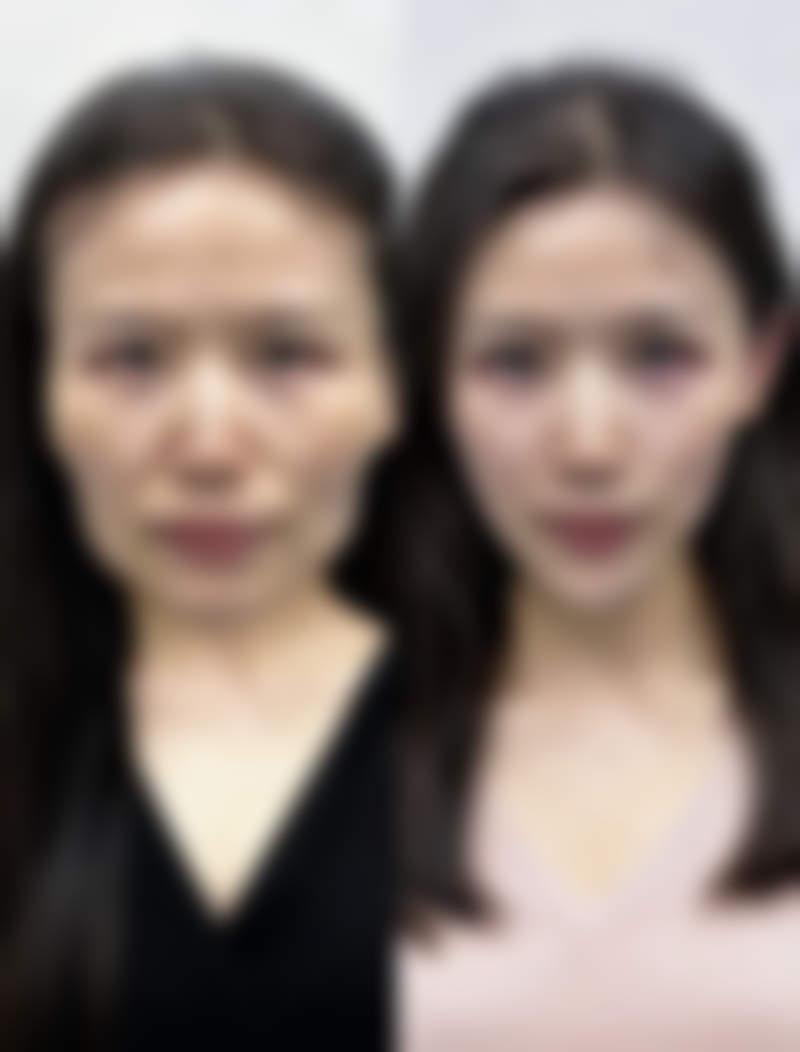 去除疤痕疙瘩后如何进行护理呢