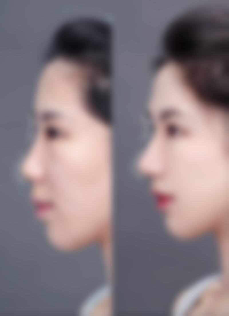 全切双眼皮多久能吃牛肉——陈涛医生所在医院