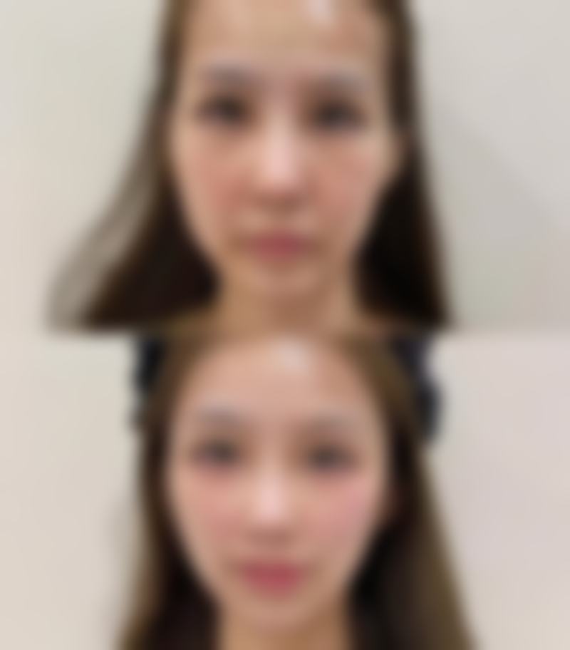 三等甲医院瘦脸针成效可以持续多久的原因剖析