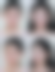 全切双眼皮切眼袋消肿情况——成都李波医生工作室