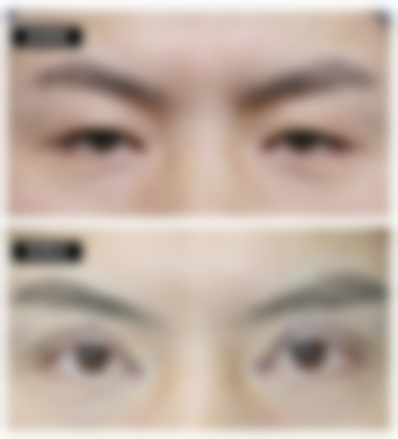 夏天能做双眼皮吗——福州黄祖根医生坐诊机构