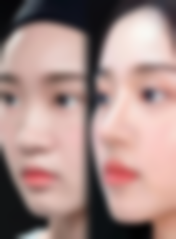 硅胶假体隆胸常见问题快问快答