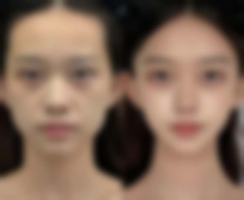 全切双眼皮切眼袋消肿情况——南京艺星医疗美容医院