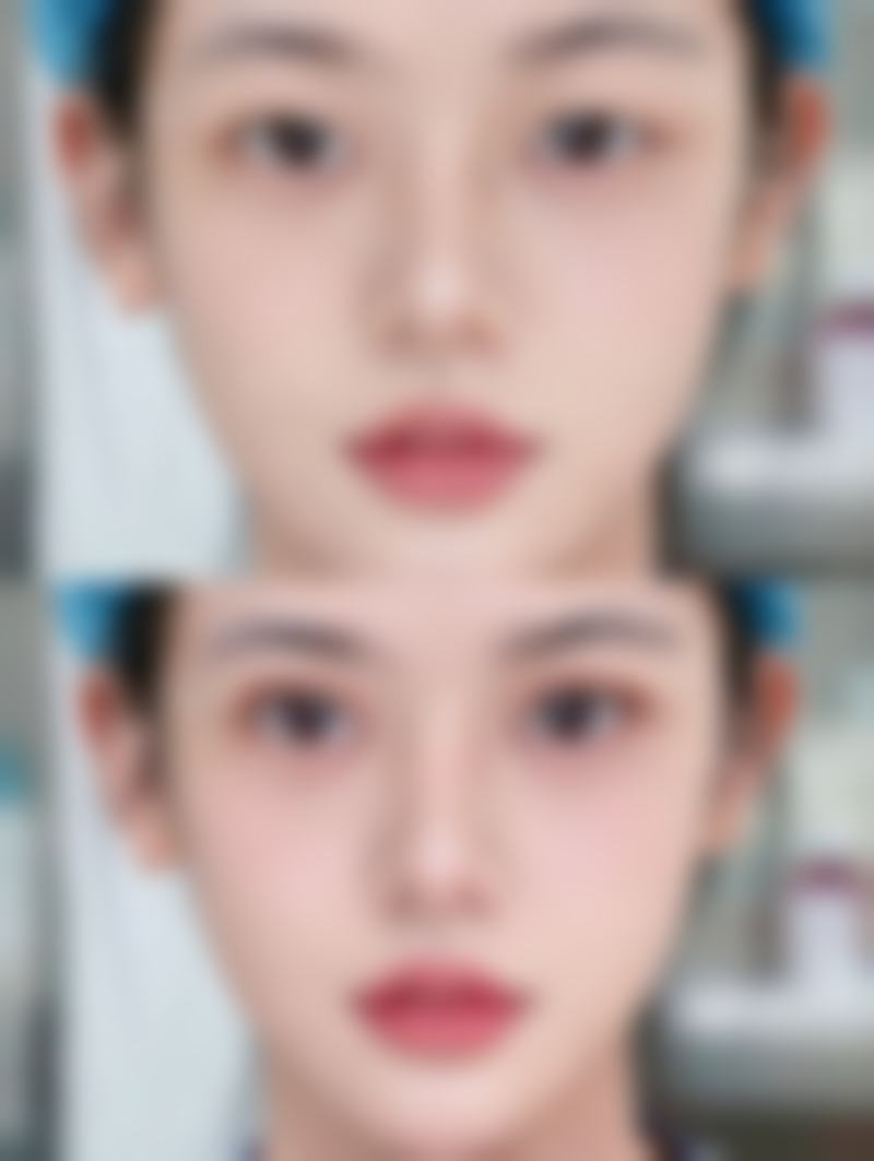 夏天能做双眼皮吗？术后护理+恢复优势，李东杨锴医生专业解答