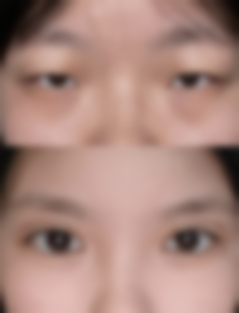 全切双眼皮切眼袋消肿情况——平顶山郭老大整形医院