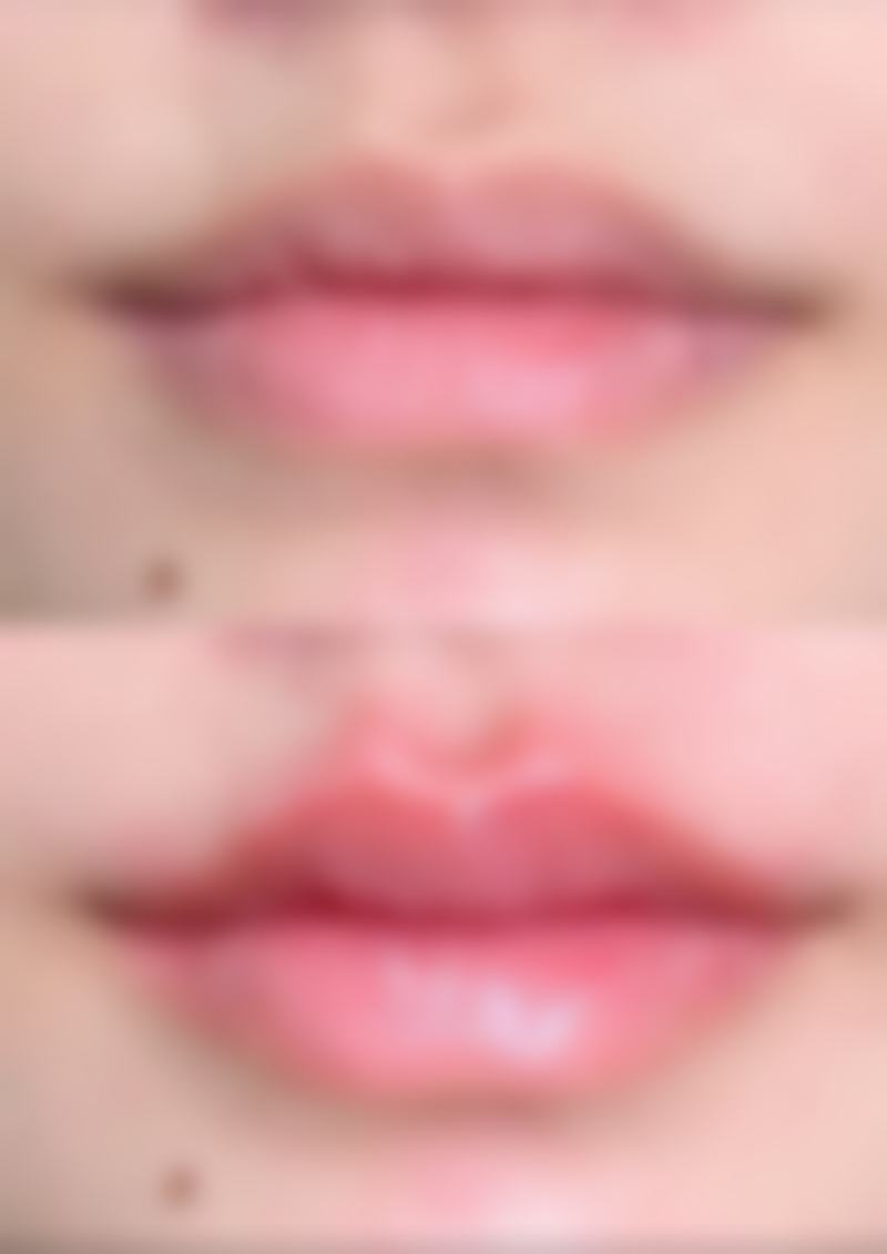 儿童和面部疤痕增生黑色素沉淀的特殊情况