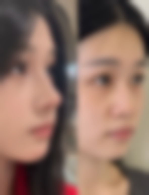 杭州联合丽格解读吸脂后3个月做射频紧肤的科学性