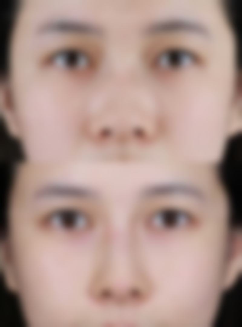 50岁做双眼皮全切的费用分析