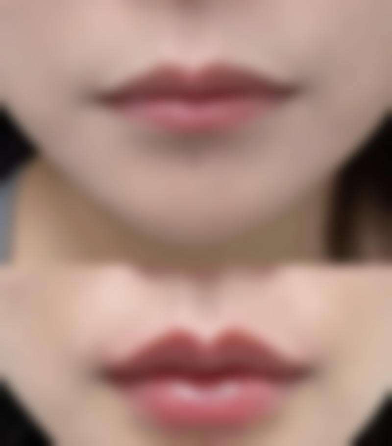 专精医院激光去除疤痕疙瘩成效怎样呢