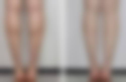 宝宝脸上的冻疮疤痕怎么去除之药物治疗显神通