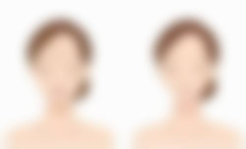 除皱针注意事项有哪些——品牌选择的诀窍