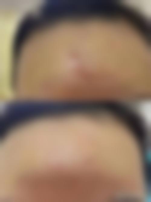 长了疤痕疙瘩怎么办？个性化修复方案+陈继峰、韩东亮名医推荐